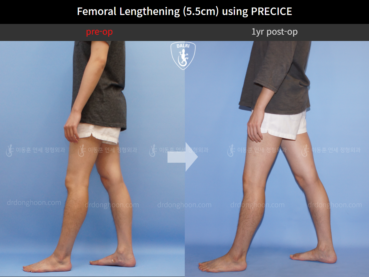Before and after cll precice, case 4323383, image 3, Dr. Donghoon institute (DALRI)