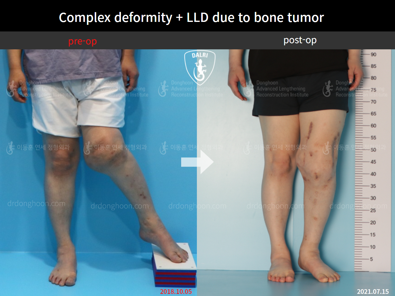 Before and after complex deformity, case 9107737, image 1, Dr. Donghoon institute (DALRI)