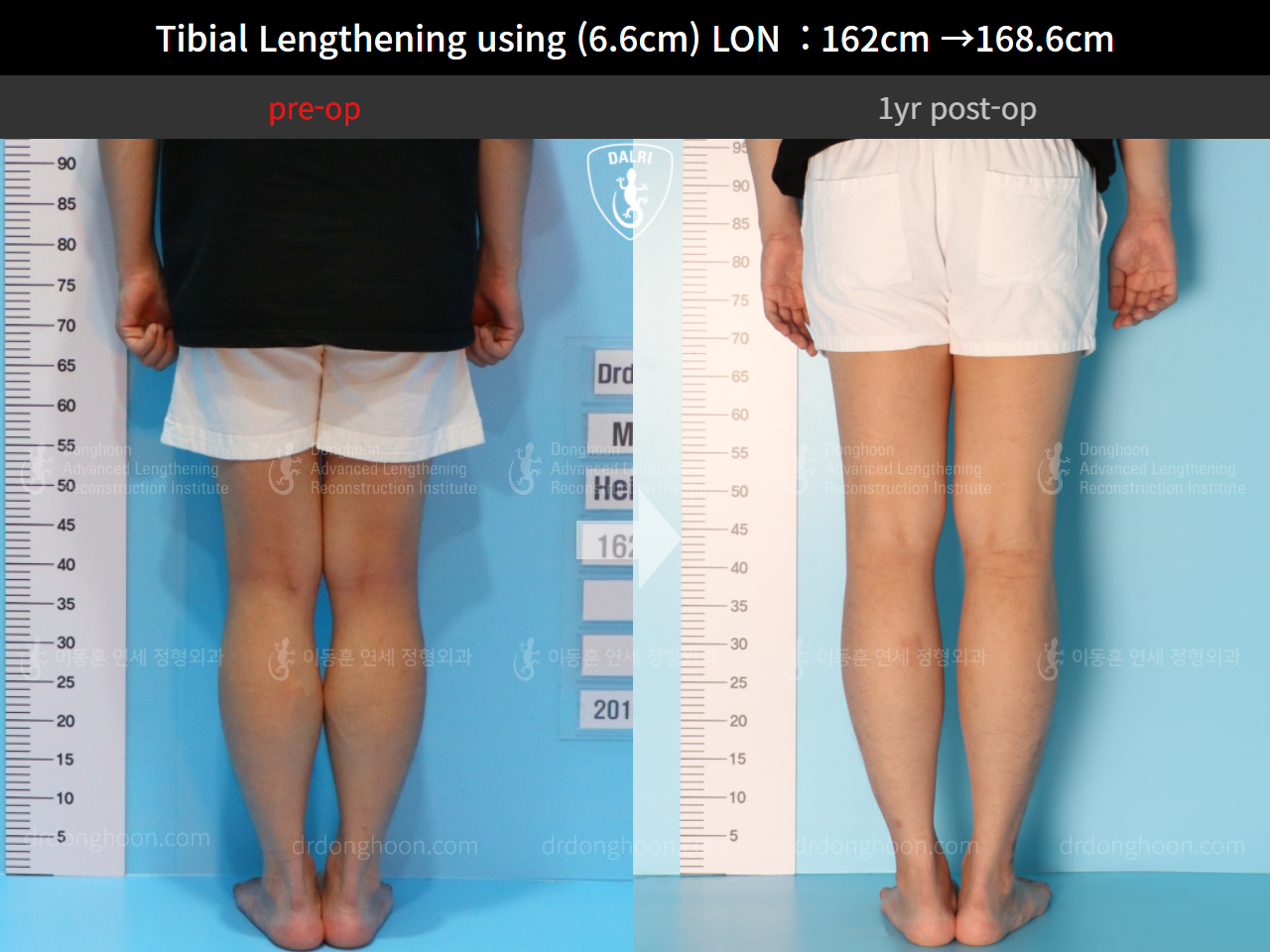 Before and after cll lon, case 4577769, image 6, Dr. Donghoon institute (DALRI)