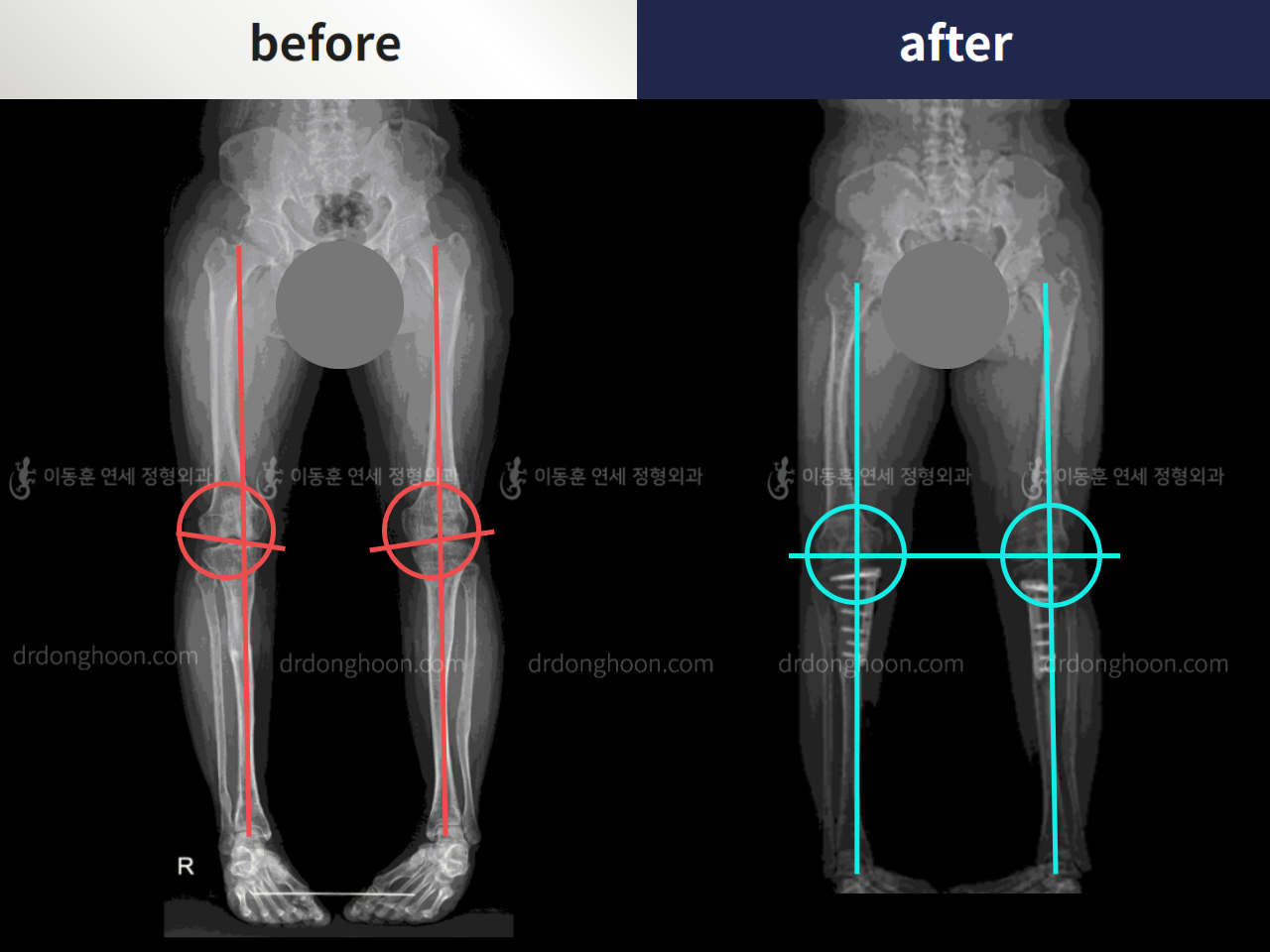 Before and after congenital condition, case 5271121, image 4, Dr. Donghoon institute (DALRI)