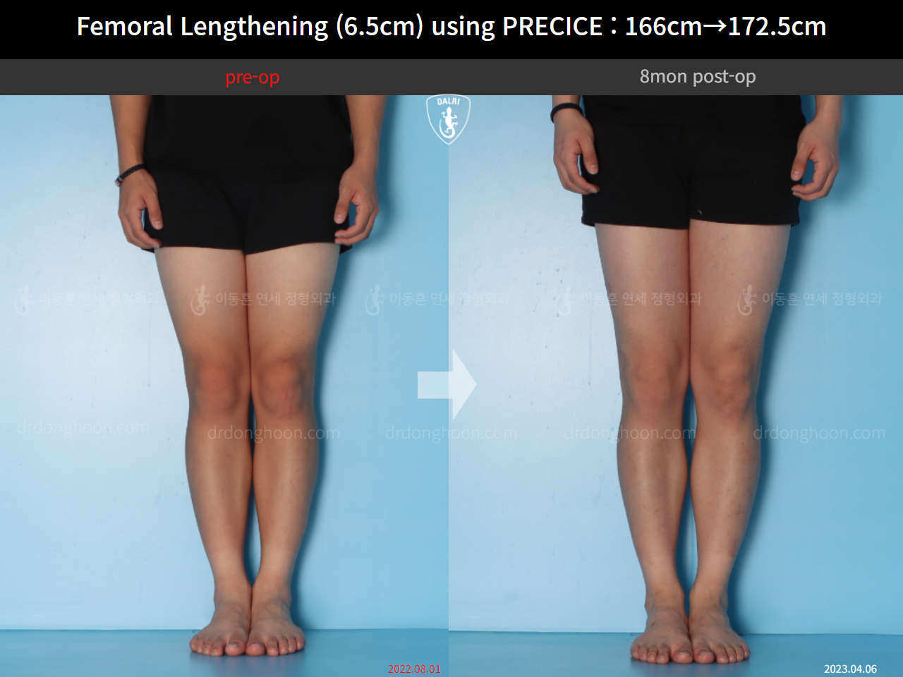 Before and after cll precice, case 14706614, image 9, Dr. Donghoon institute (DALRI)