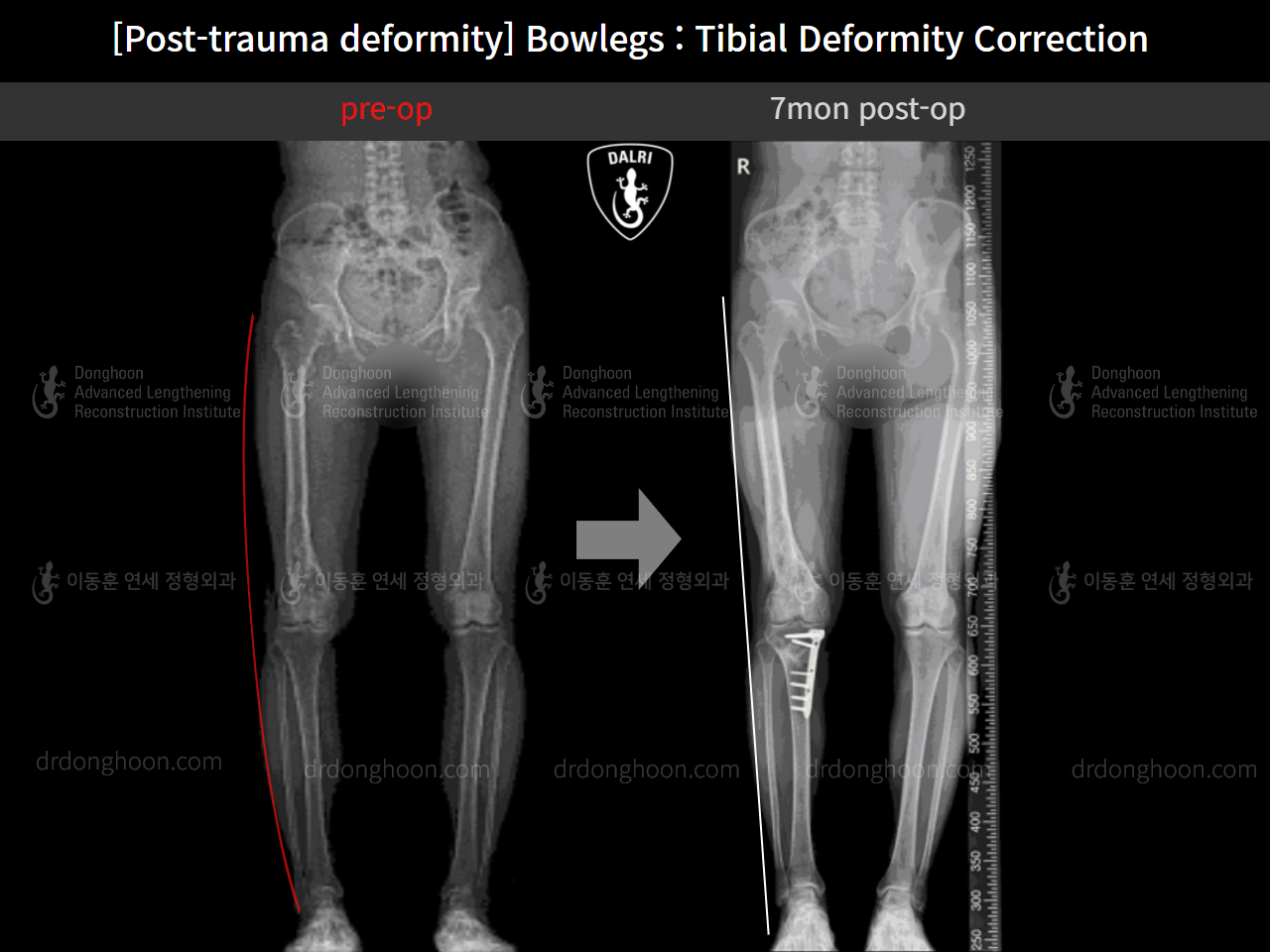 Before and after osteotomy for knee osteoarthritis, case 10389290, image 5, Dr. Donghoon institute (DALRI)