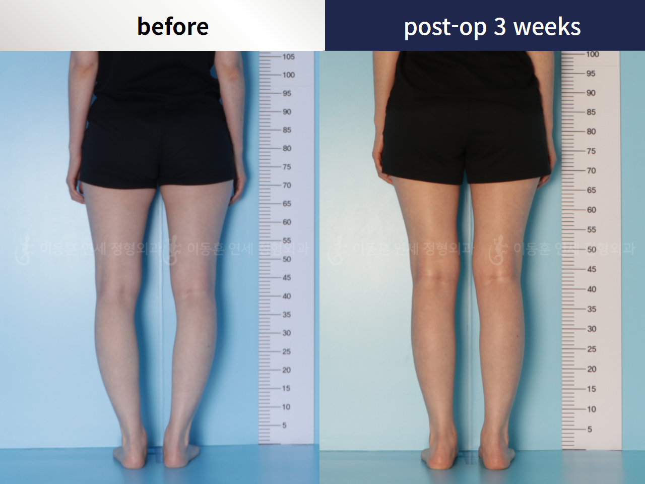 Before and after adult bowlegs, case 5953950, image 3, Dr. Donghoon institute (DALRI)