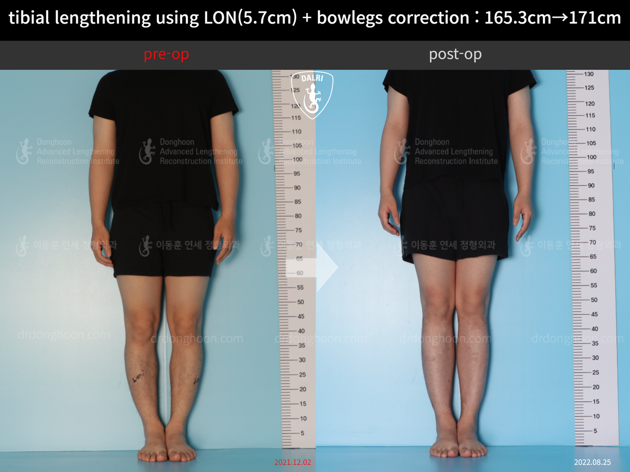 Before and after cll + deformity correction, case 12679153, image 1, Dr. Donghoon institute (DALRI)