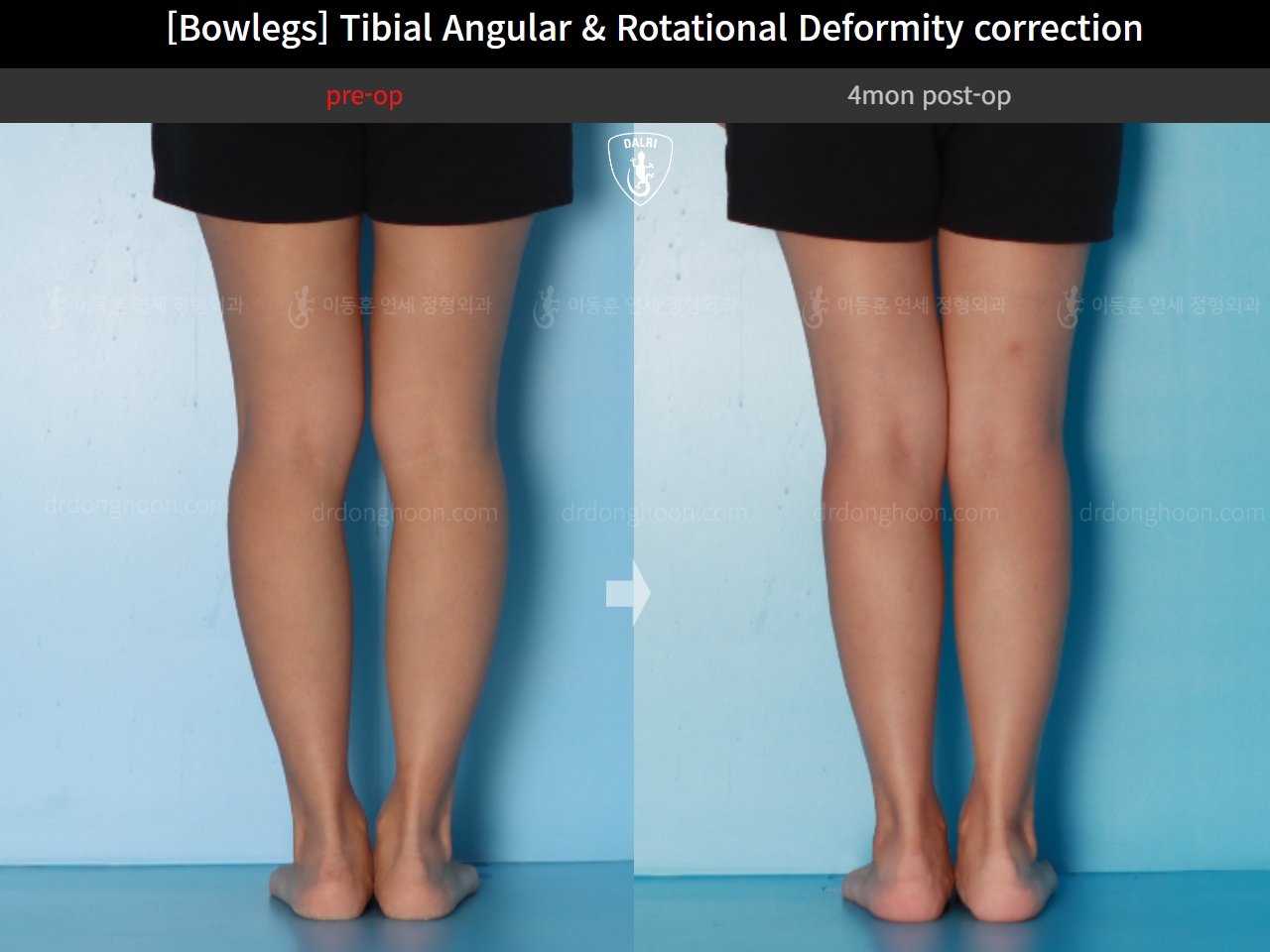 Before and after adult bowlegs, case 16530390, image 9, Dr. Donghoon institute (DALRI)