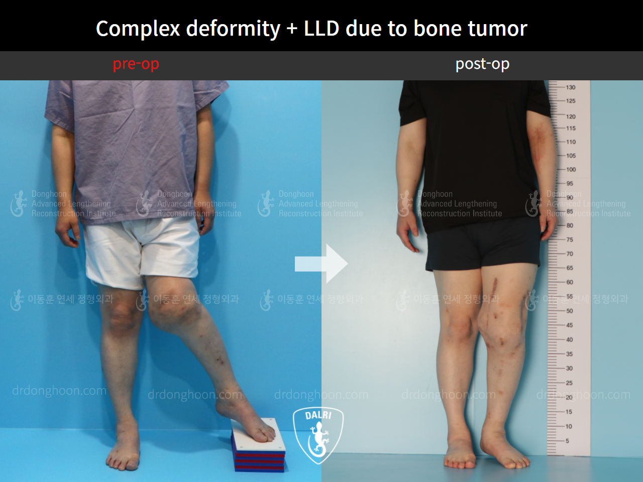 Before and after post-trauma deformity, case 4535705, image 2, Dr. Donghoon institute (DALRI)