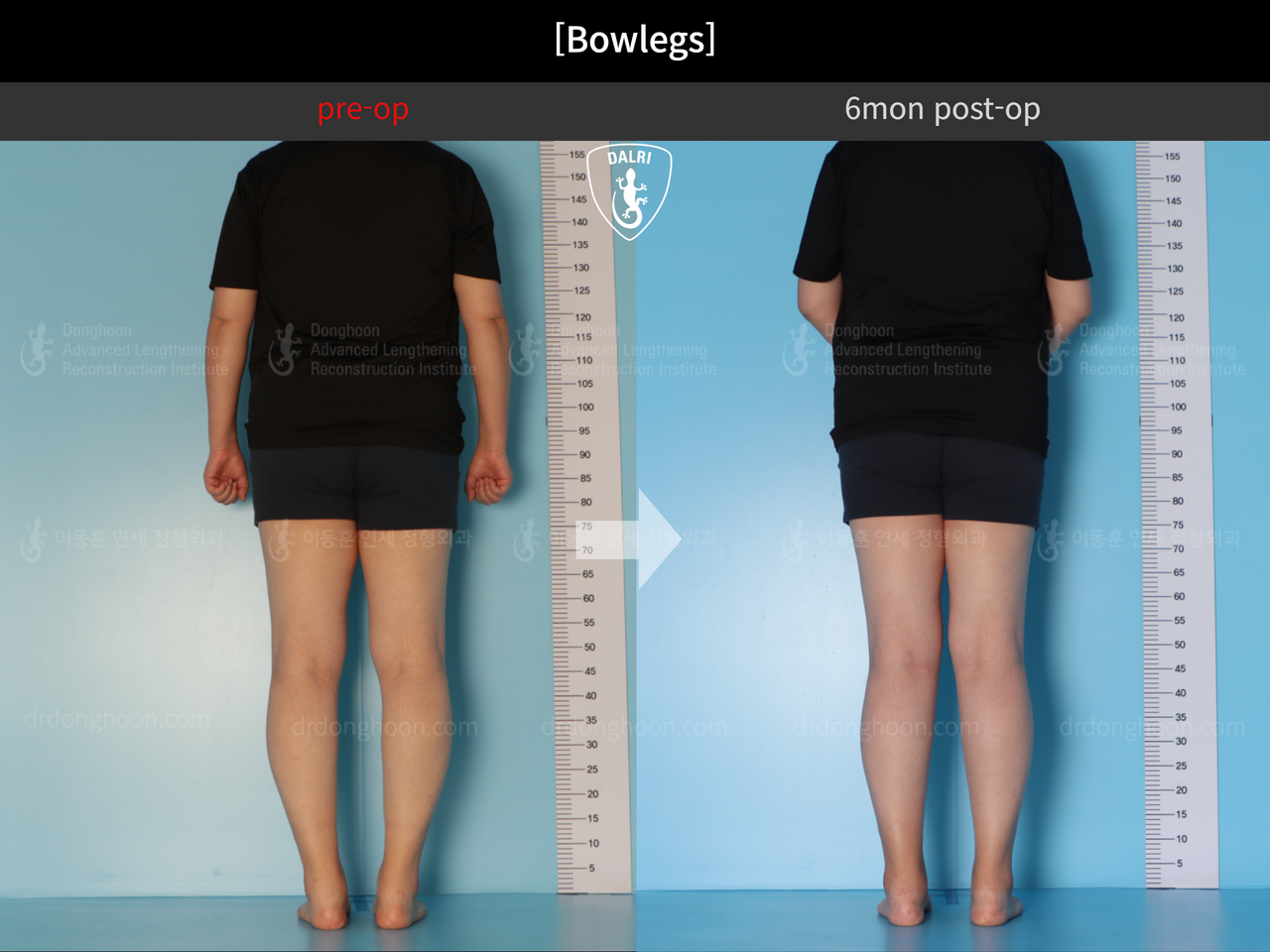 Before and after adult bowlegs, case 12396052, image 4, Dr. Donghoon institute (DALRI)