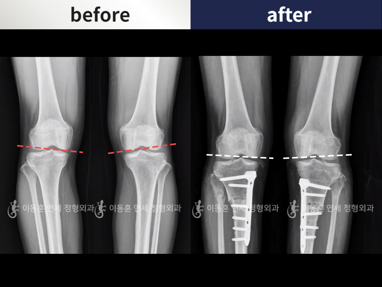 Before and after adult bowlegs, case 5968800, image 1, Dr. Donghoon institute (DALRI)