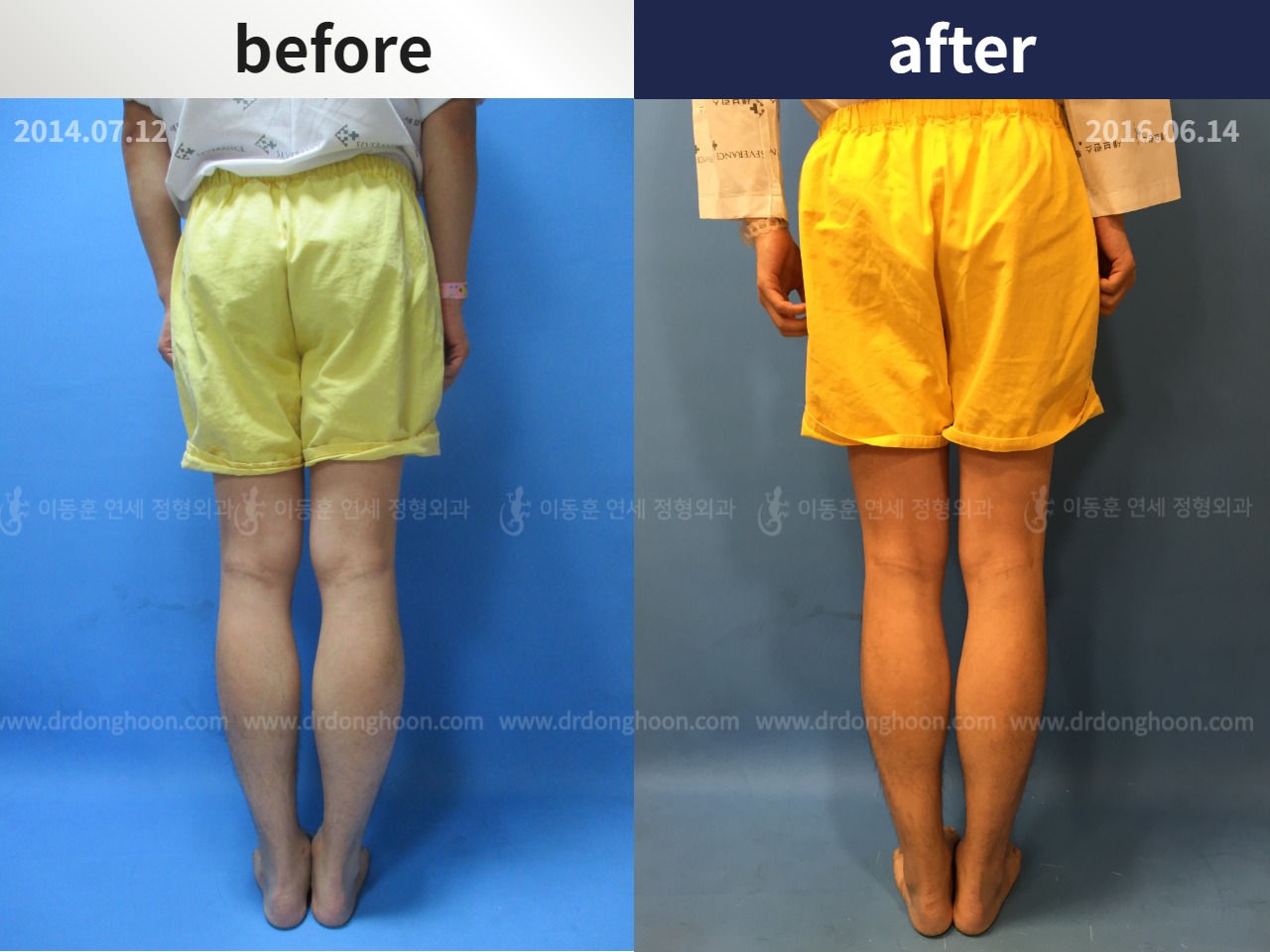 Before and after cll precice, case 4323389, image 2, Dr. Donghoon institute (DALRI)