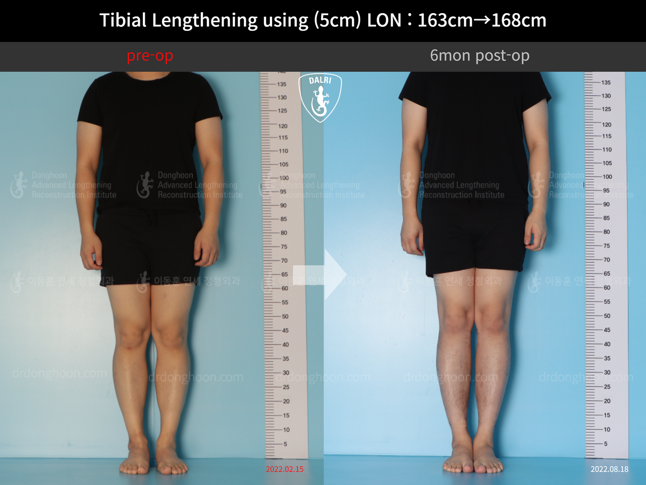 Before and after cll lon, case 12638628, image 1, Dr. Donghoon institute (DALRI)