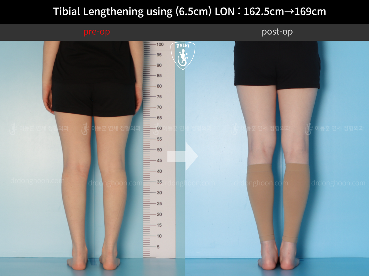 Tibial Lengthening Using (6.5cm) LON : 162.5cm→169cm : DALRI Before & After