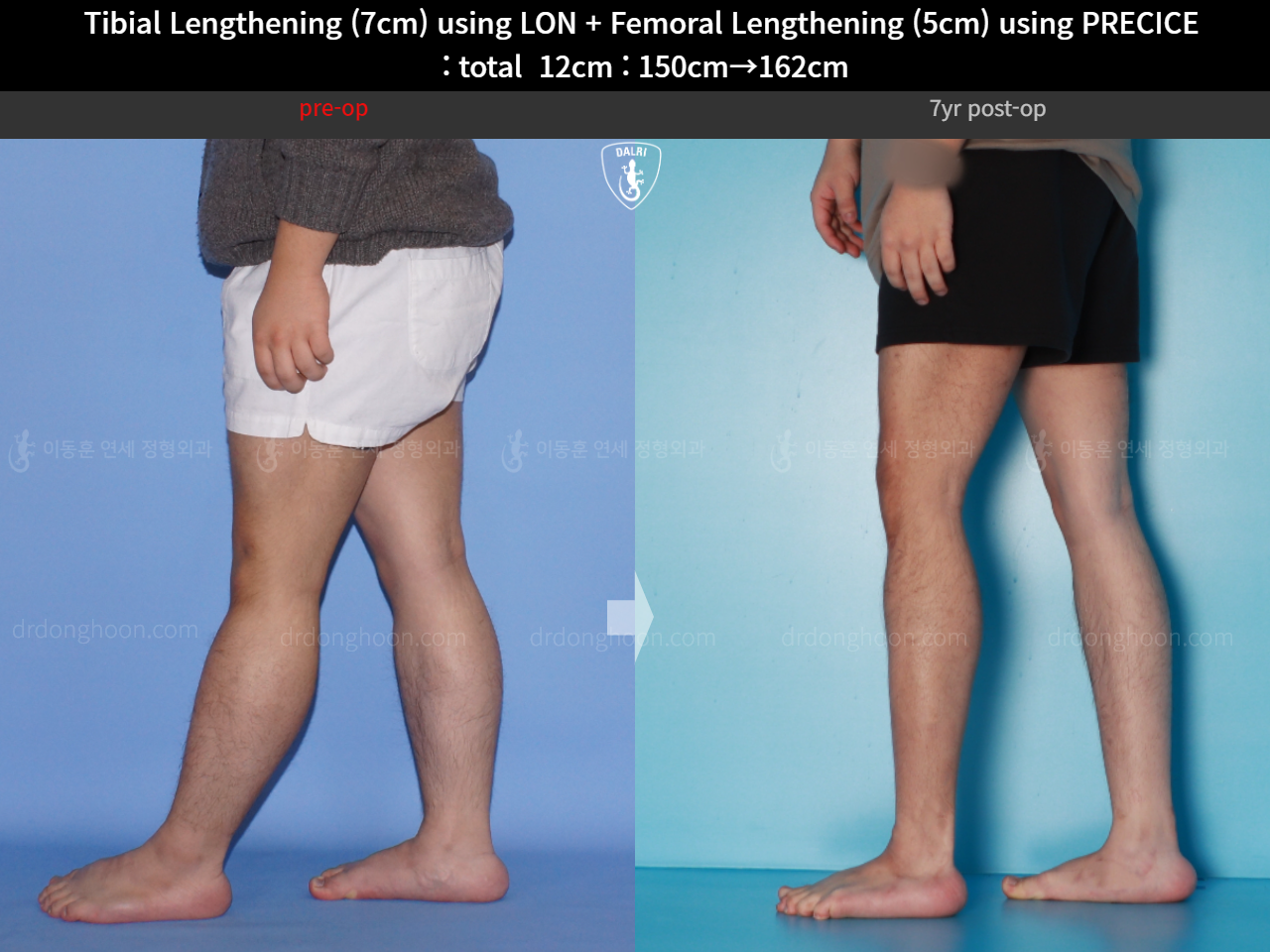Before and after cll precice, case 16146445, image 12, Dr. Donghoon institute (DALRI)