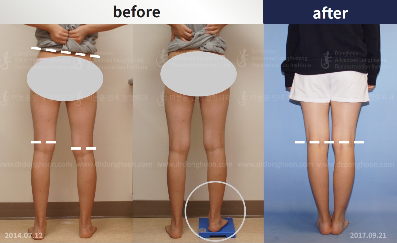 Before and after paediatric & adolescent lld, case 4320411, image 2, Dr. Donghoon institute (DALRI)