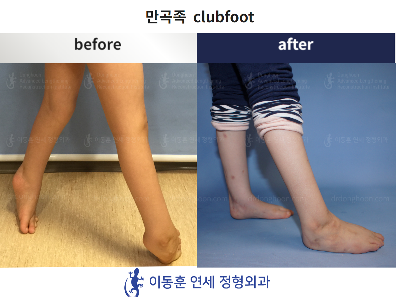 Before and after paediatric congenital condition, case 4304743, image 2, Dr. Donghoon institute (DALRI)