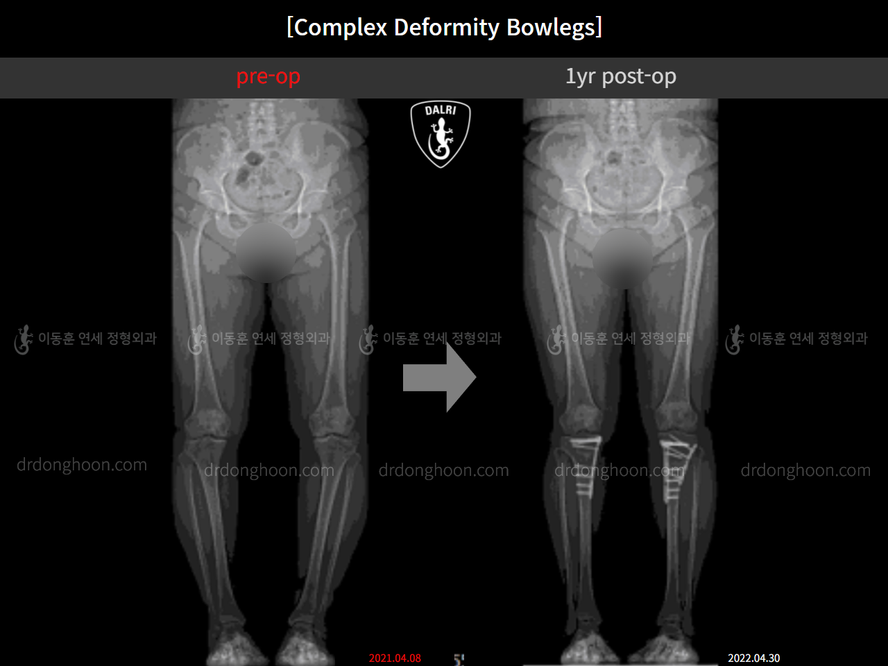 Before and after complex deformity, case 11339608, image 8, Dr. Donghoon institute (DALRI)
