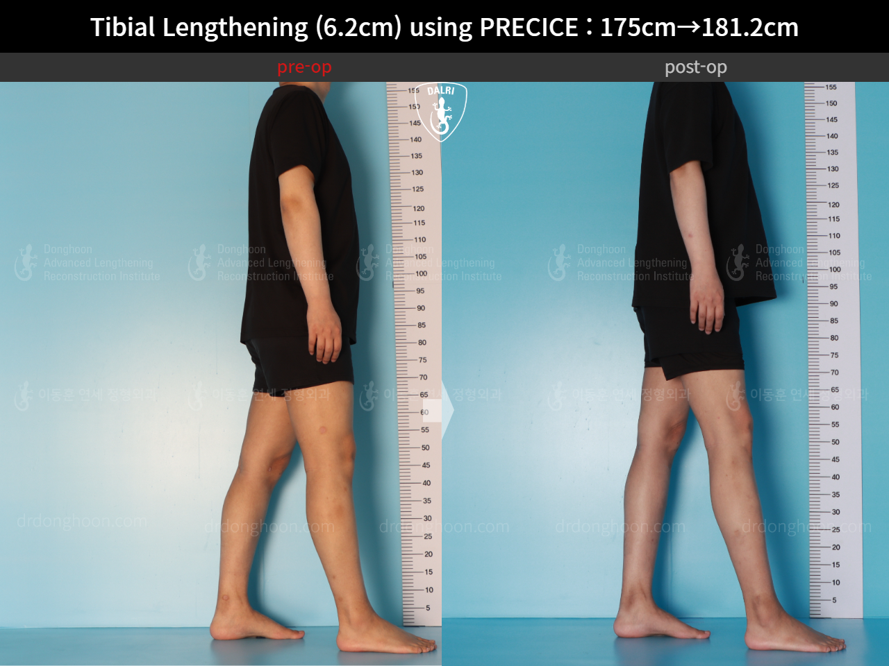Before and after cll precice, case 16277428, image 7, Dr. Donghoon institute (DALRI)