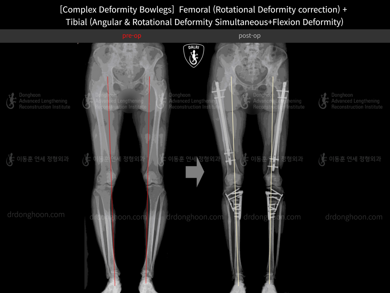 Before and after adult bowlegs, case 13185726, image 4, Dr. Donghoon institute (DALRI)