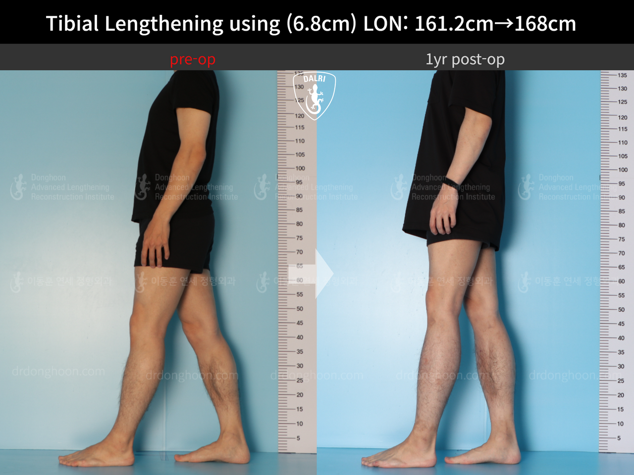 Before and after cll lon, case 13633878, image 3, Dr. Donghoon institute (DALRI)