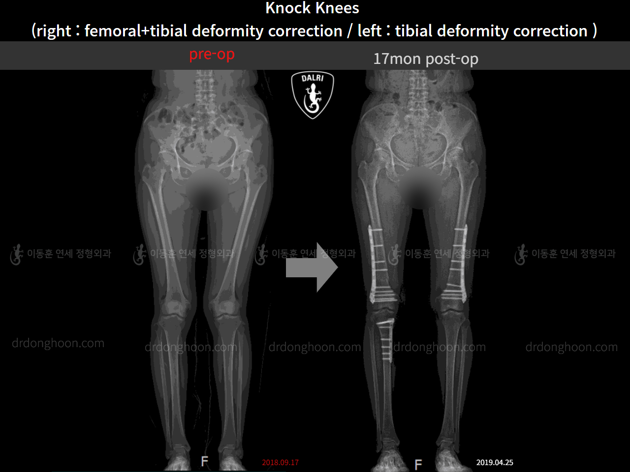 Before and after adult knock knees, case 4640565, image 6, Dr. Donghoon institute (DALRI)