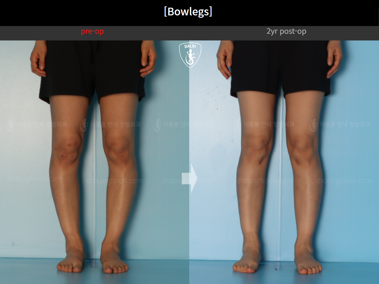 Before and after adult bowlegs, case 20942169, image 8, Dr. Donghoon institute (DALRI)