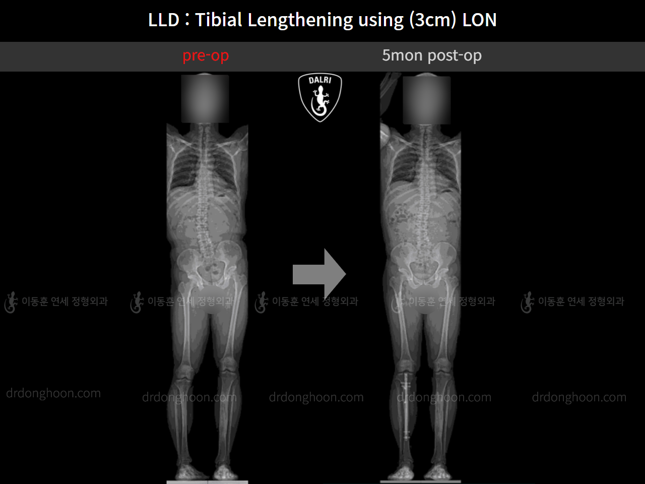 Before and after adult lld, case 11139768, image 7, Dr. Donghoon institute (DALRI)