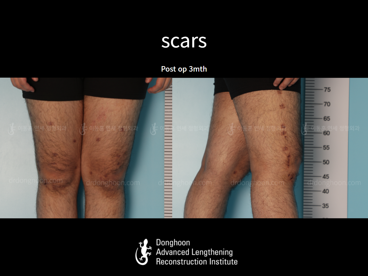 Before and after adult knock knees, case 7165631, image 8, Dr. Donghoon institute (DALRI)