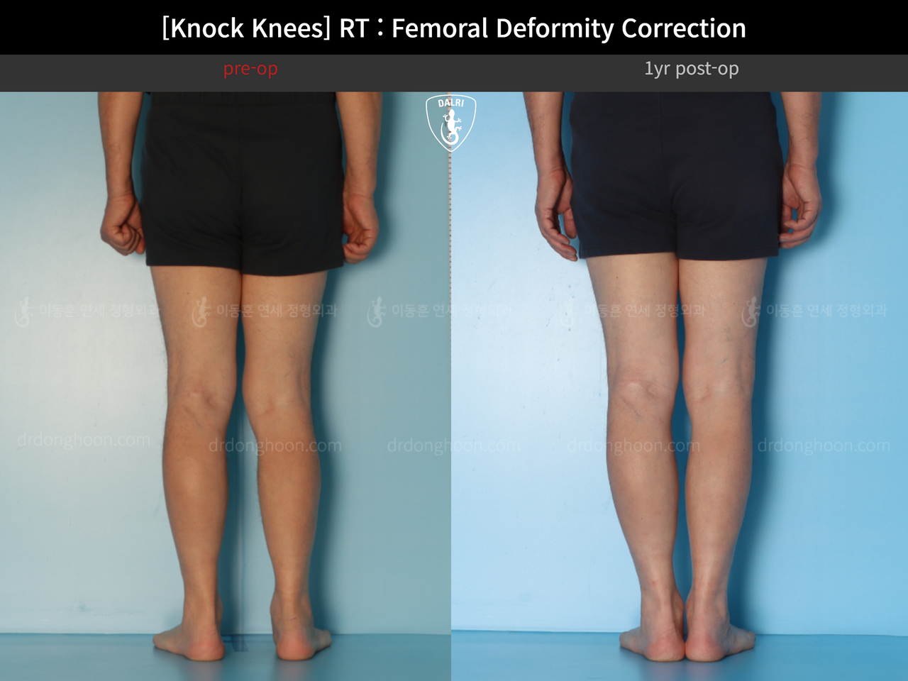 Before and after flexion deformity, case 14236440, image 6, Dr. Donghoon institute (DALRI)