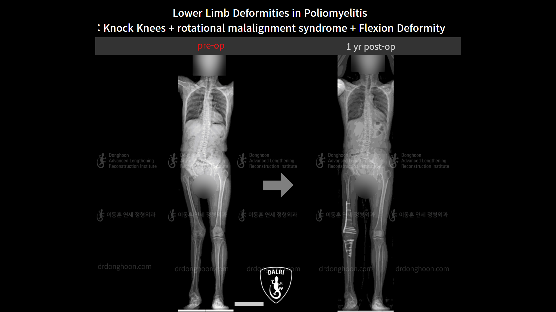 Before and after adult knock knees, case 9154930, image 6, Dr. Donghoon institute (DALRI)