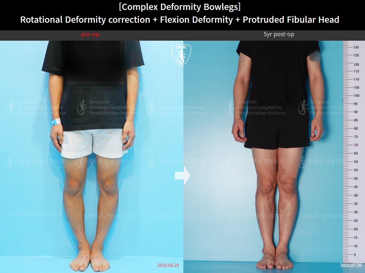 Before and after adult bowlegs, case 15944746, image 3, Dr. Donghoon institute (DALRI)
