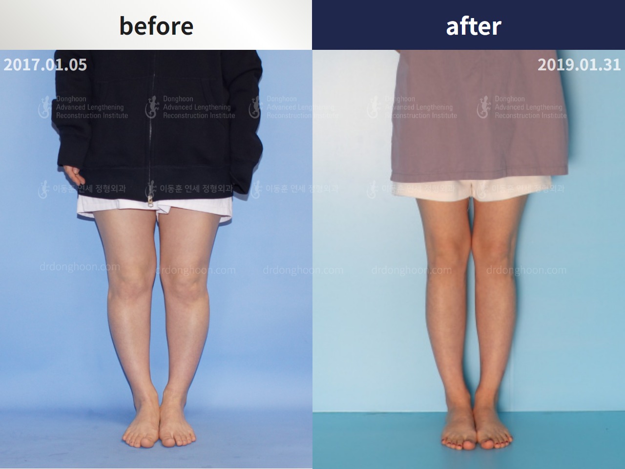 Before and after adult bowlegs, case 4310962, image 1, Dr. Donghoon institute (DALRI)