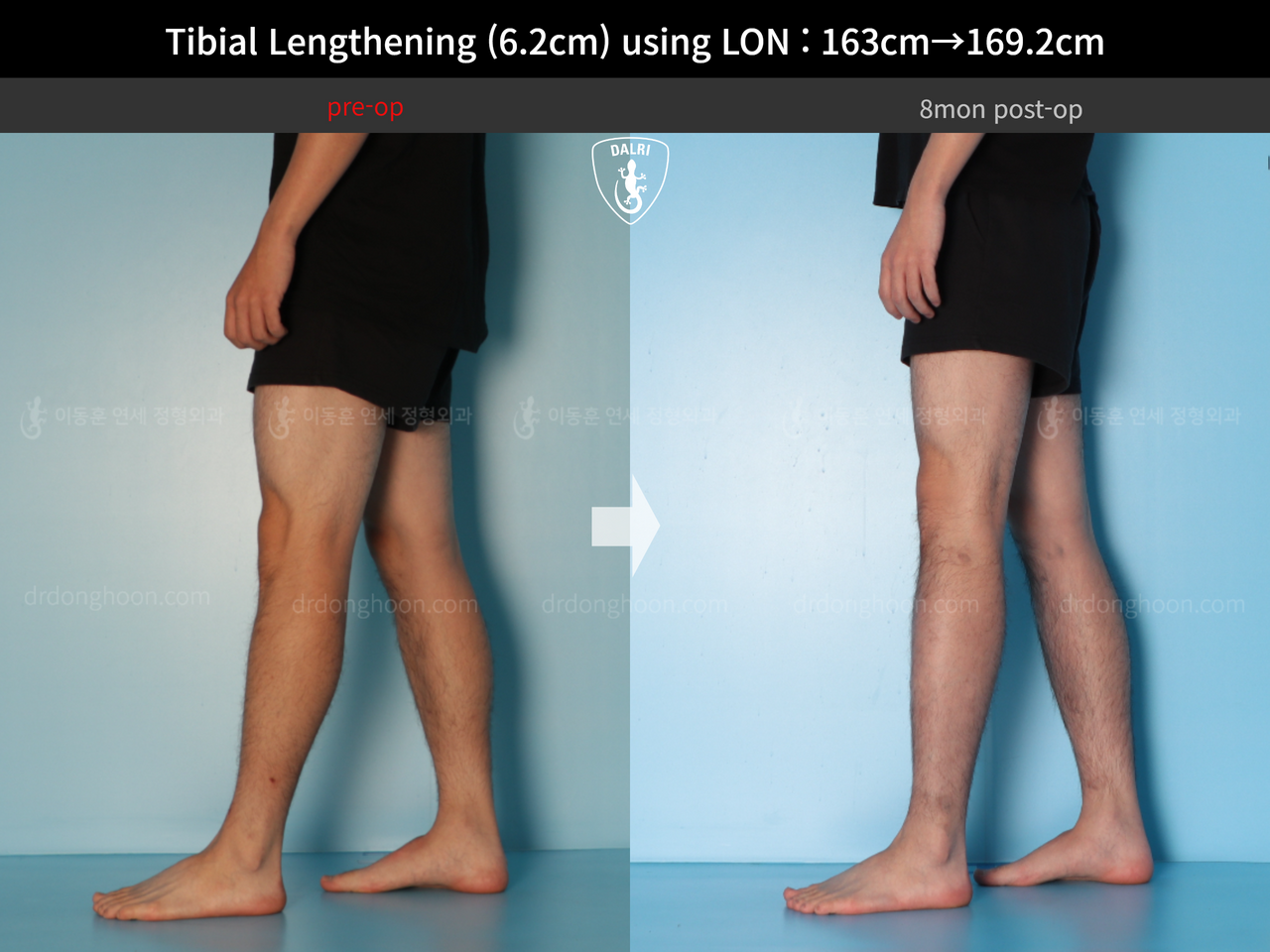 Before and after cll lon, case 14135787, image 10, Dr. Donghoon institute (DALRI)