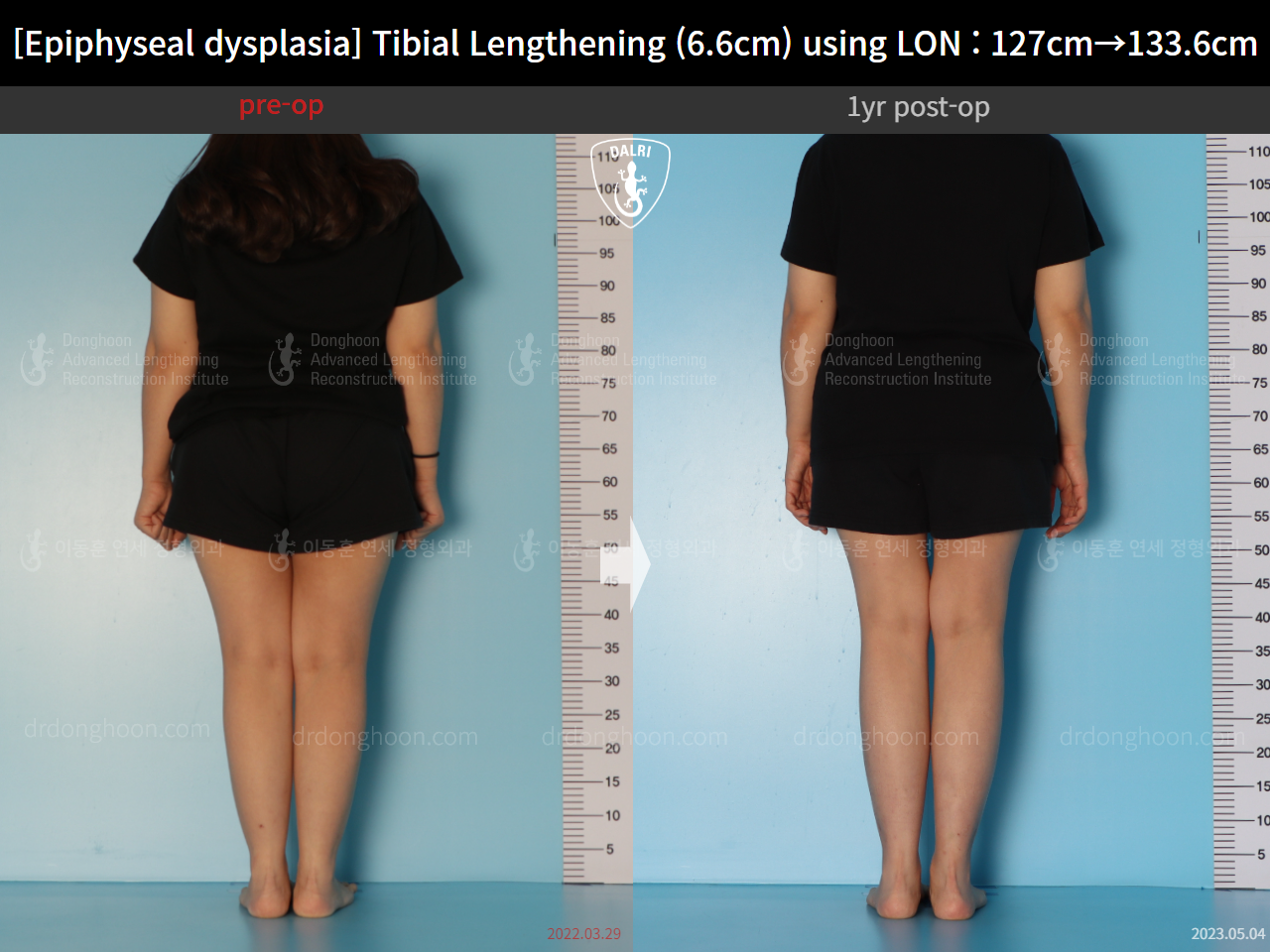 Before and after congenital condition, case 15072062, image 3, Dr. Donghoon institute (DALRI)