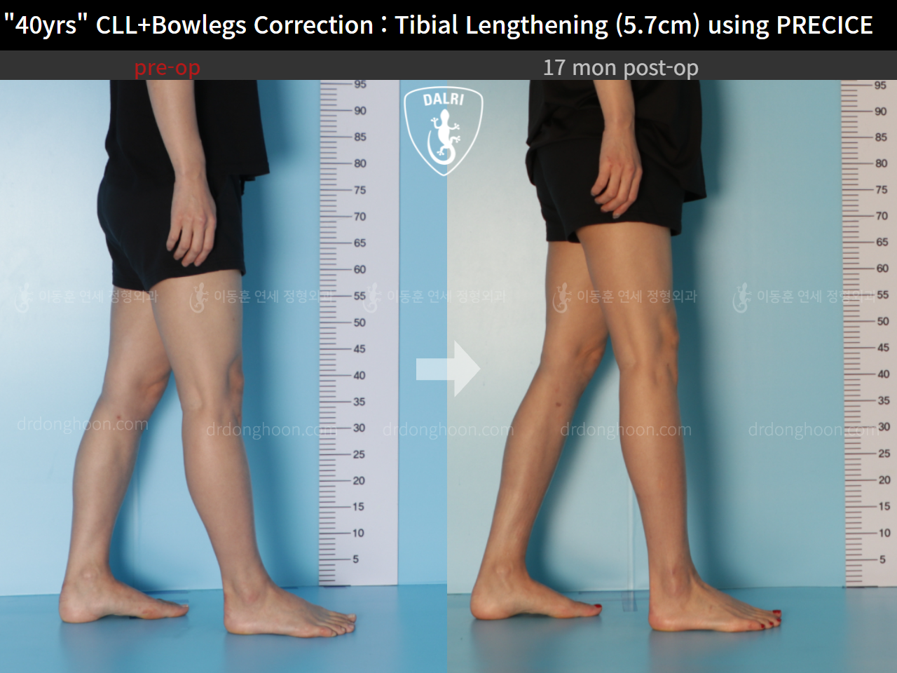 Before and after cll + deformity correction, case 9180907, image 7, Dr. Donghoon institute (DALRI)