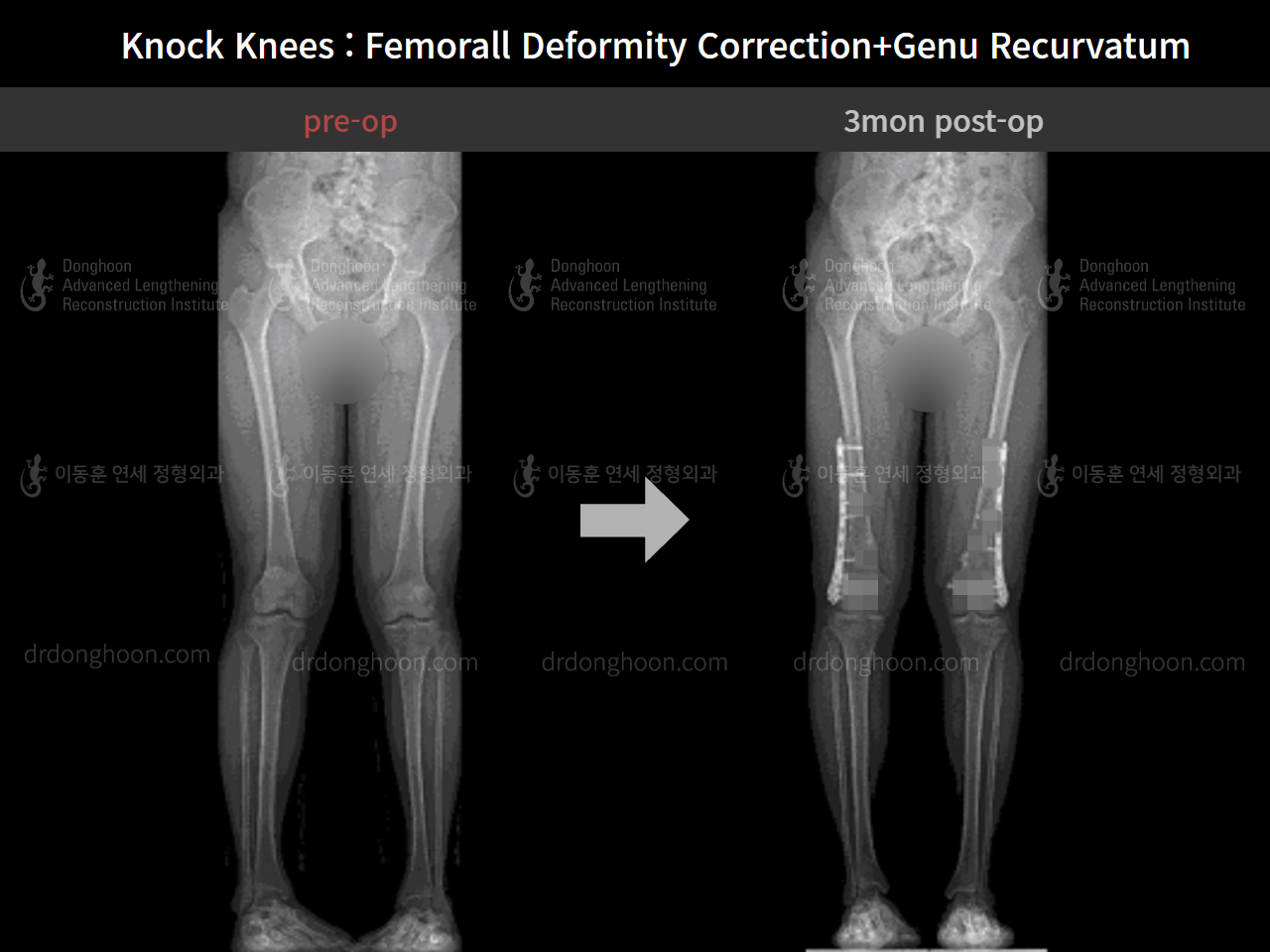 Before and after adult knock knees, case 7165631, image 5, Dr. Donghoon institute (DALRI)