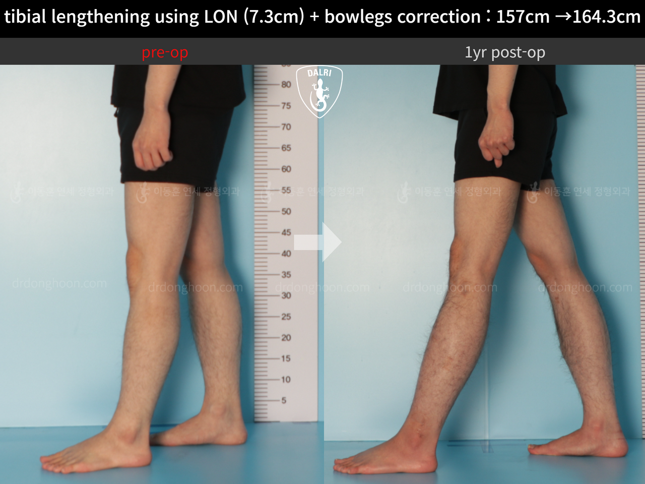Before and after cll + deformity correction, case 13152543, image 8, Dr. Donghoon institute (DALRI)
