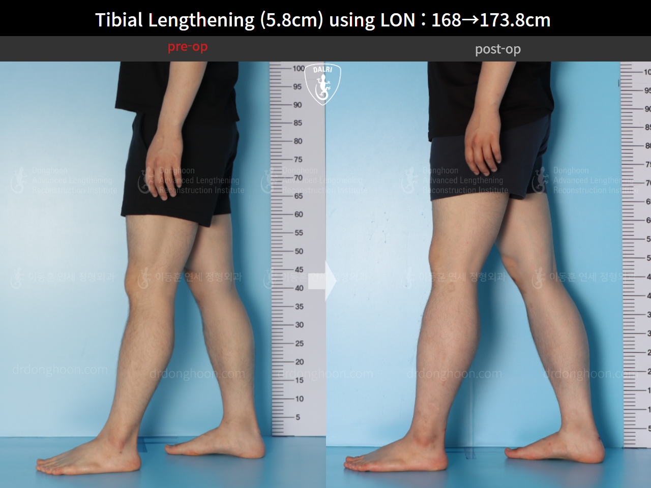 Before and after cll lon, case 15625788, image 8, Dr. Donghoon institute (DALRI)