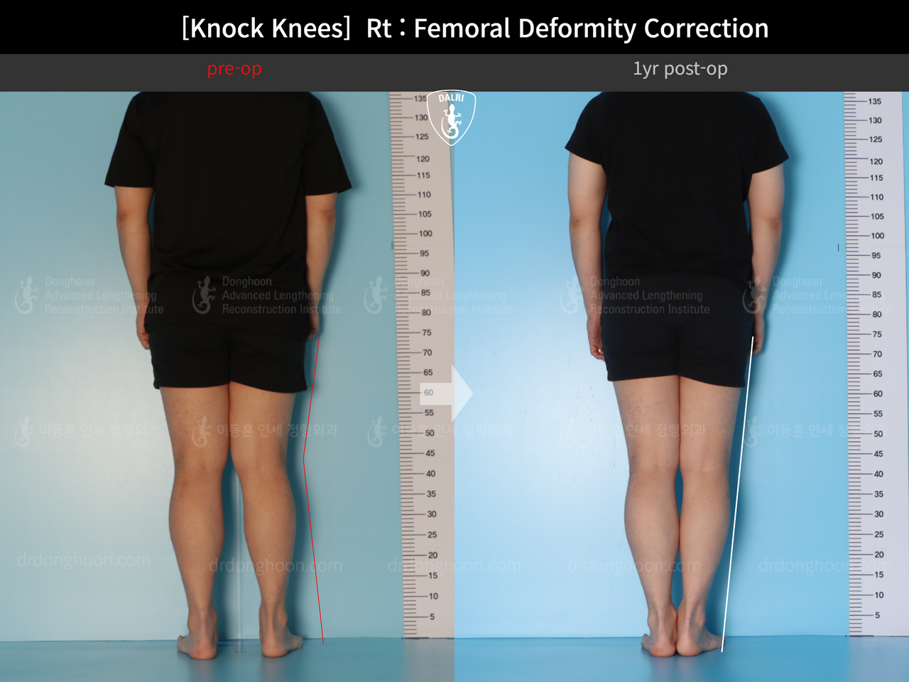 Before and after adult knock knees, case 14009233, image 2, Dr. Donghoon institute (DALRI)