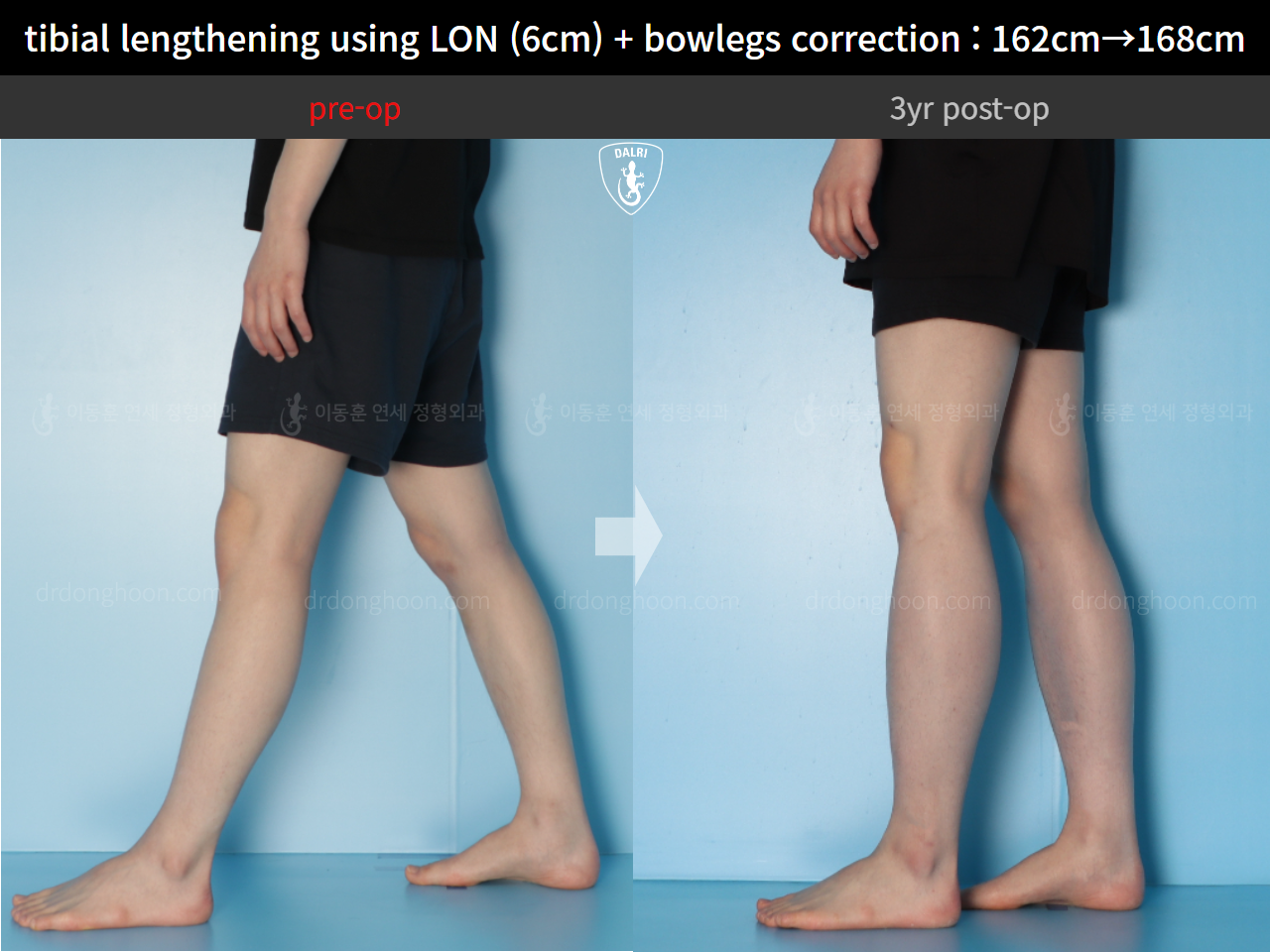 Before and after cll + deformity correction, case 14731799, image 7, Dr. Donghoon institute (DALRI)