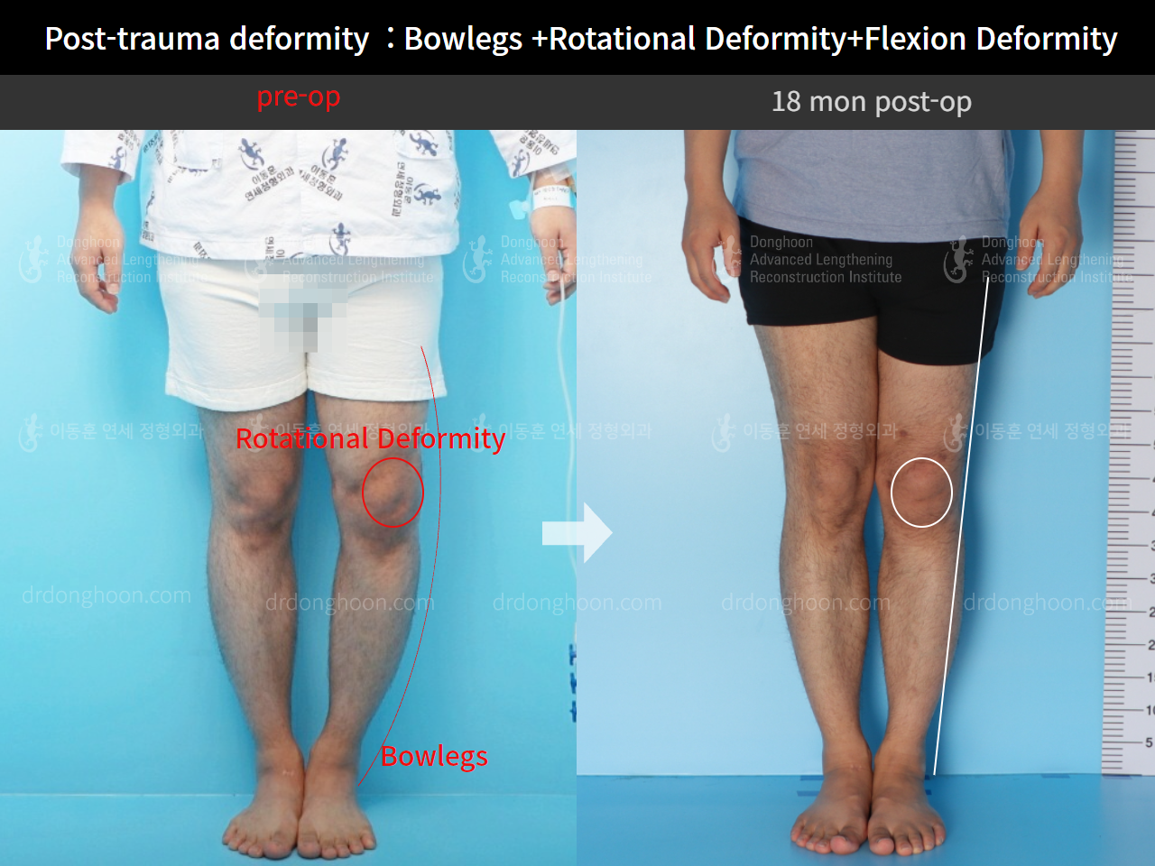 Before and after complex deformity, case 8725192, image 2, Dr. Donghoon institute (DALRI)