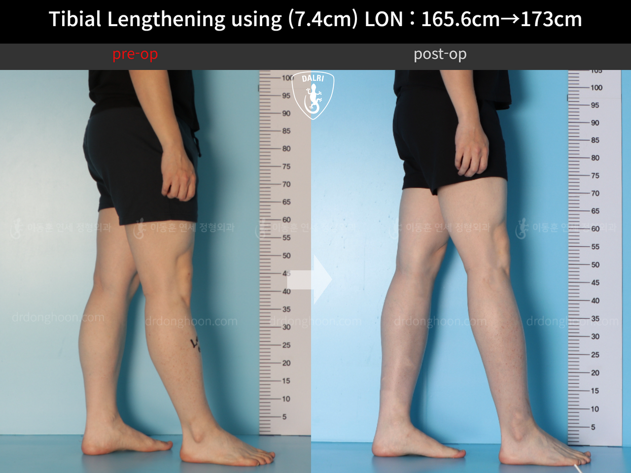 Before and after cll lon, case 13634644, image 8, Dr. Donghoon institute (DALRI)