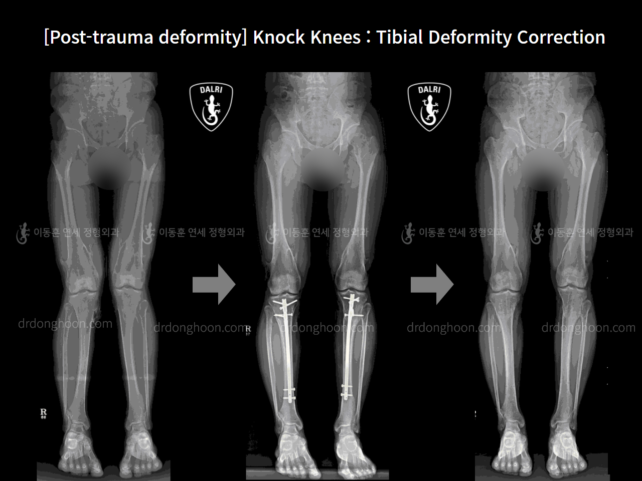 Before and after post-trauma deformity, case 9758216, image 7, Dr. Donghoon institute (DALRI)