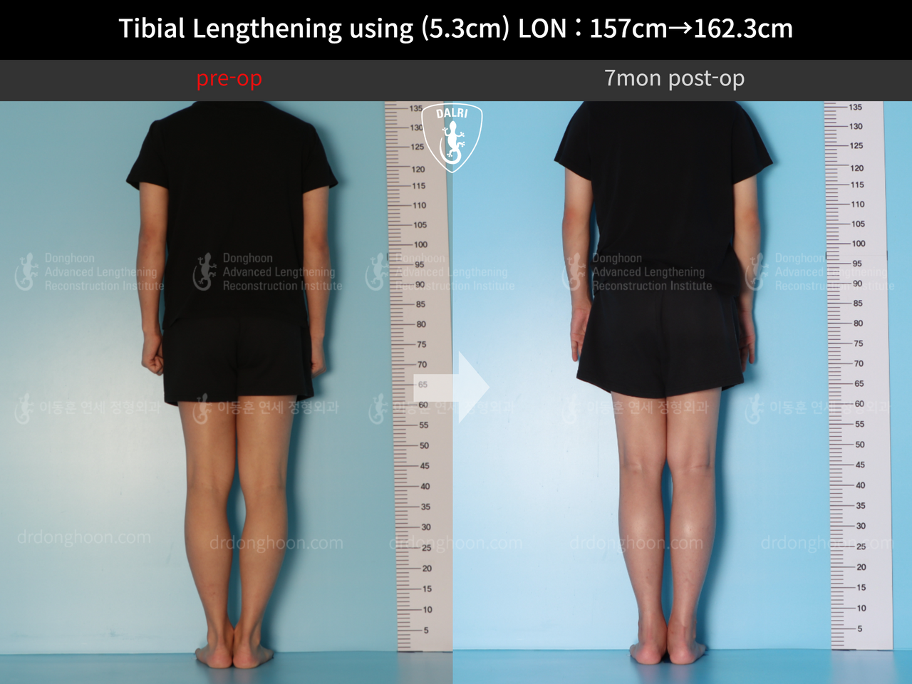 Before and after cll lon, case 12844512, image 3, Dr. Donghoon institute (DALRI)