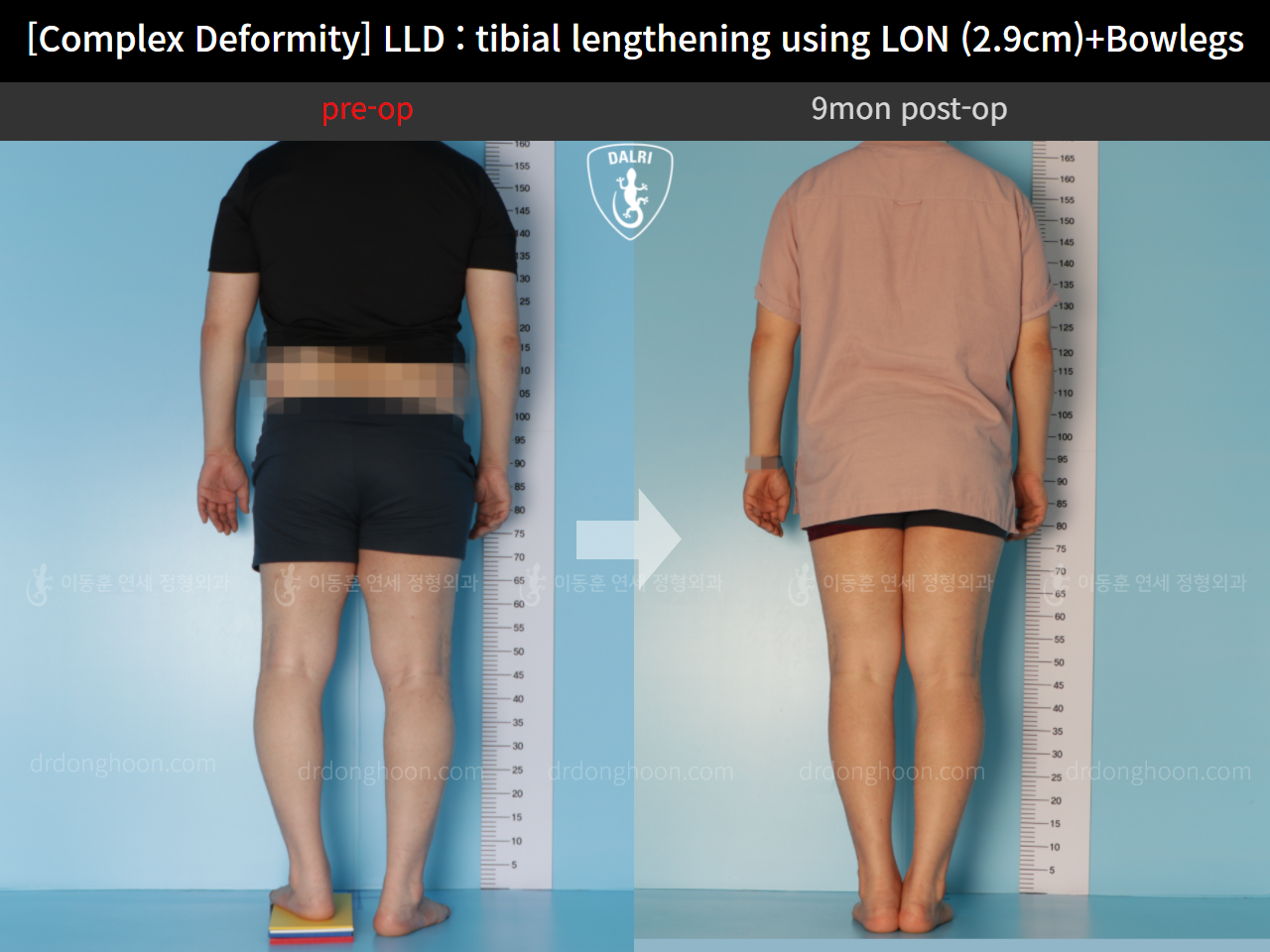 [Complex Deformity] LLD : Tibial Lengthening Using LON (2.9cm)+Bowlegs ...