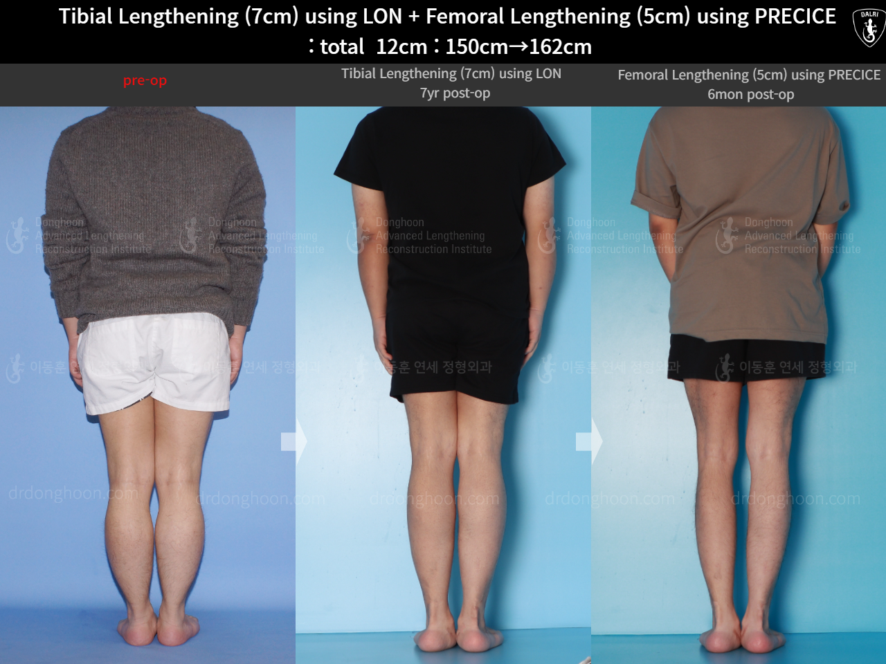 Before and after cll precice, case 16146445, image 2, Dr. Donghoon institute (DALRI)
