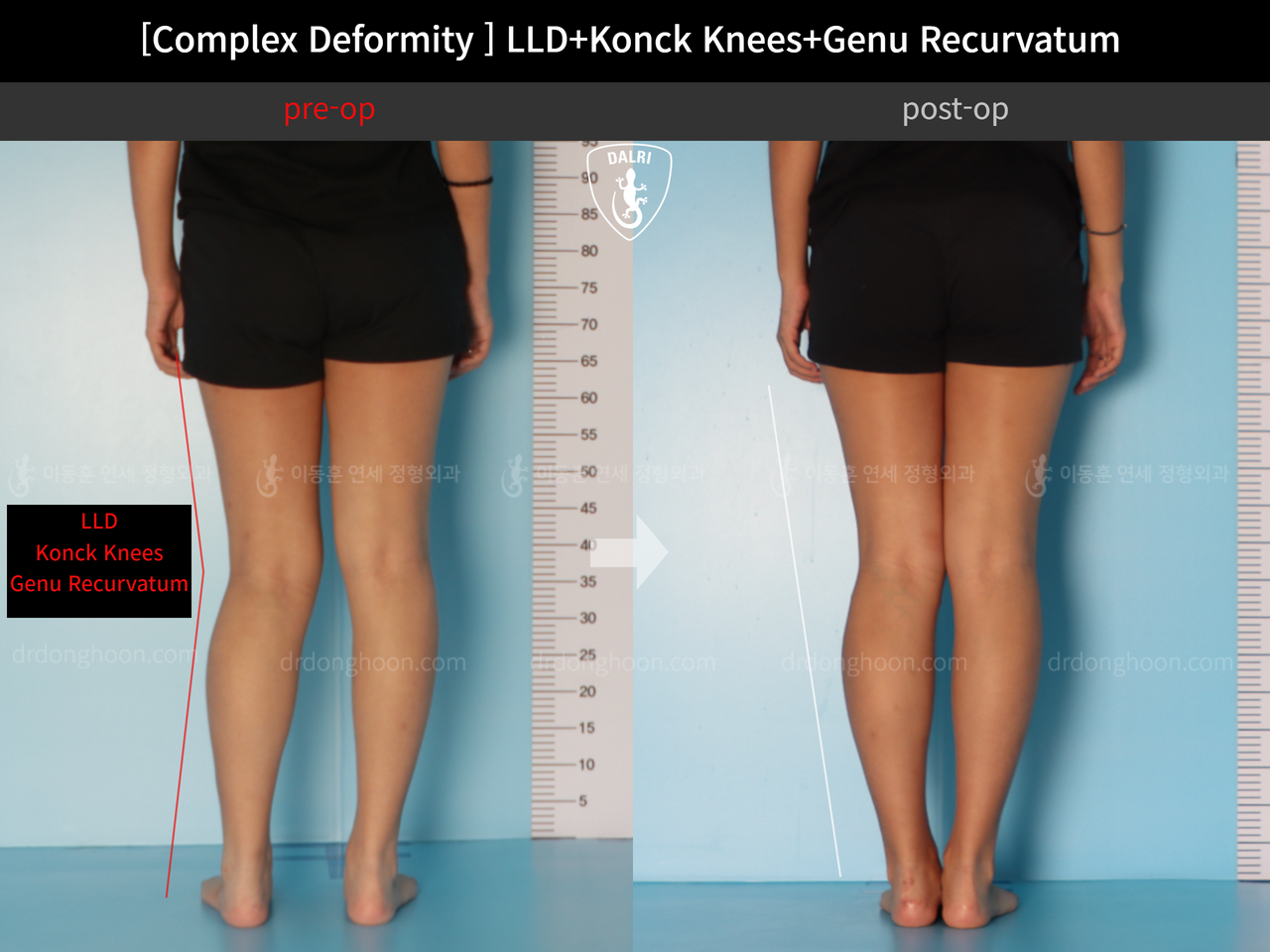 Before and after complex deformity, case 12333607, image 5, Dr. Donghoon institute (DALRI)