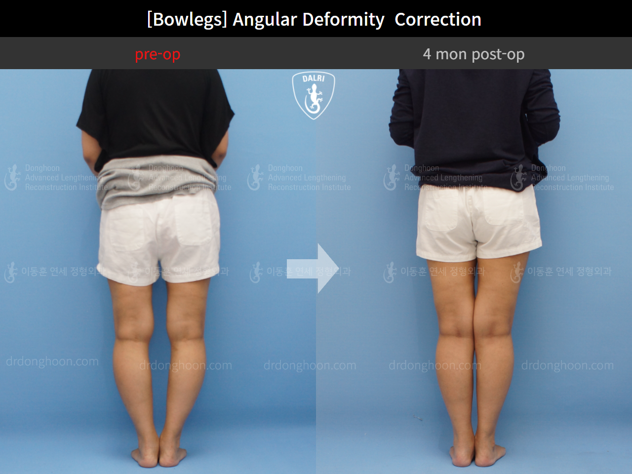 Before and after adult bowlegs, case 9289009, image 3, Dr. Donghoon institute (DALRI)