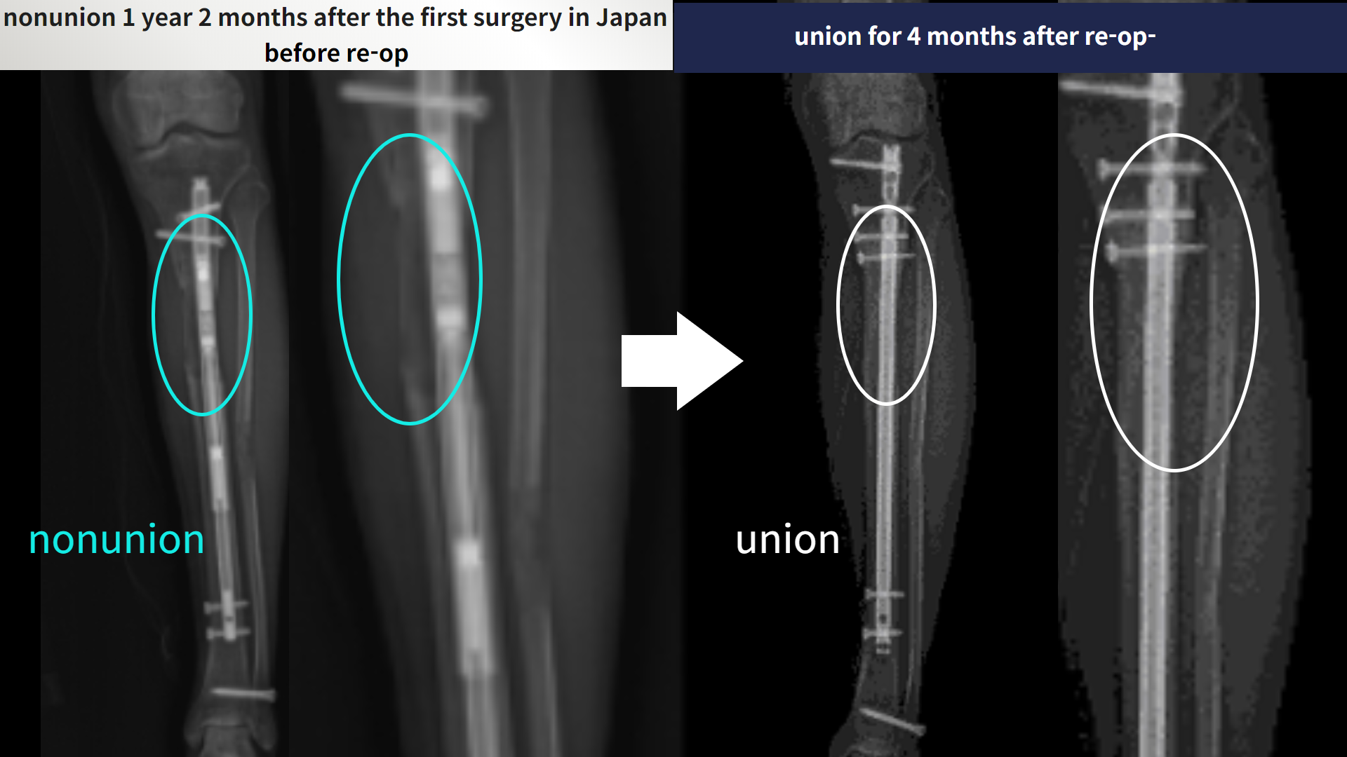 Before and after re-operation for cll, case 4465600, image 5, Dr. Donghoon institute (DALRI)