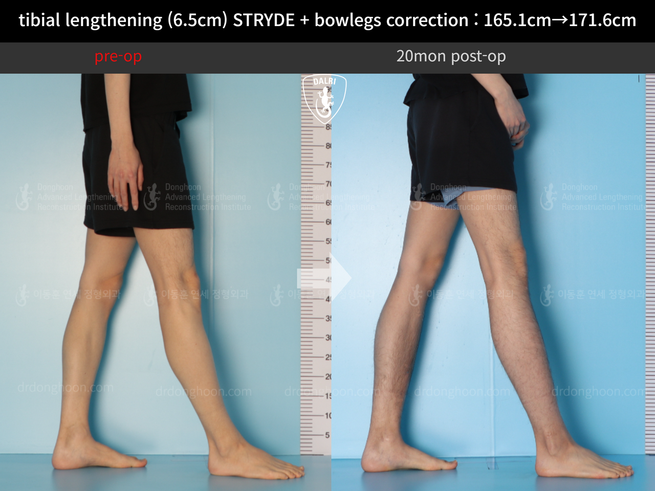 Before and after cll + deformity correction, case 13168253, image 9, Dr. Donghoon institute (DALRI)