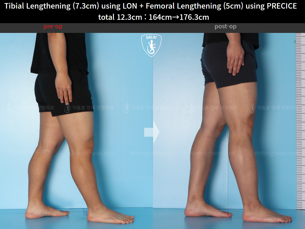 Before and after cll lon, case 15592729, image 7, Dr. Donghoon institute (DALRI)