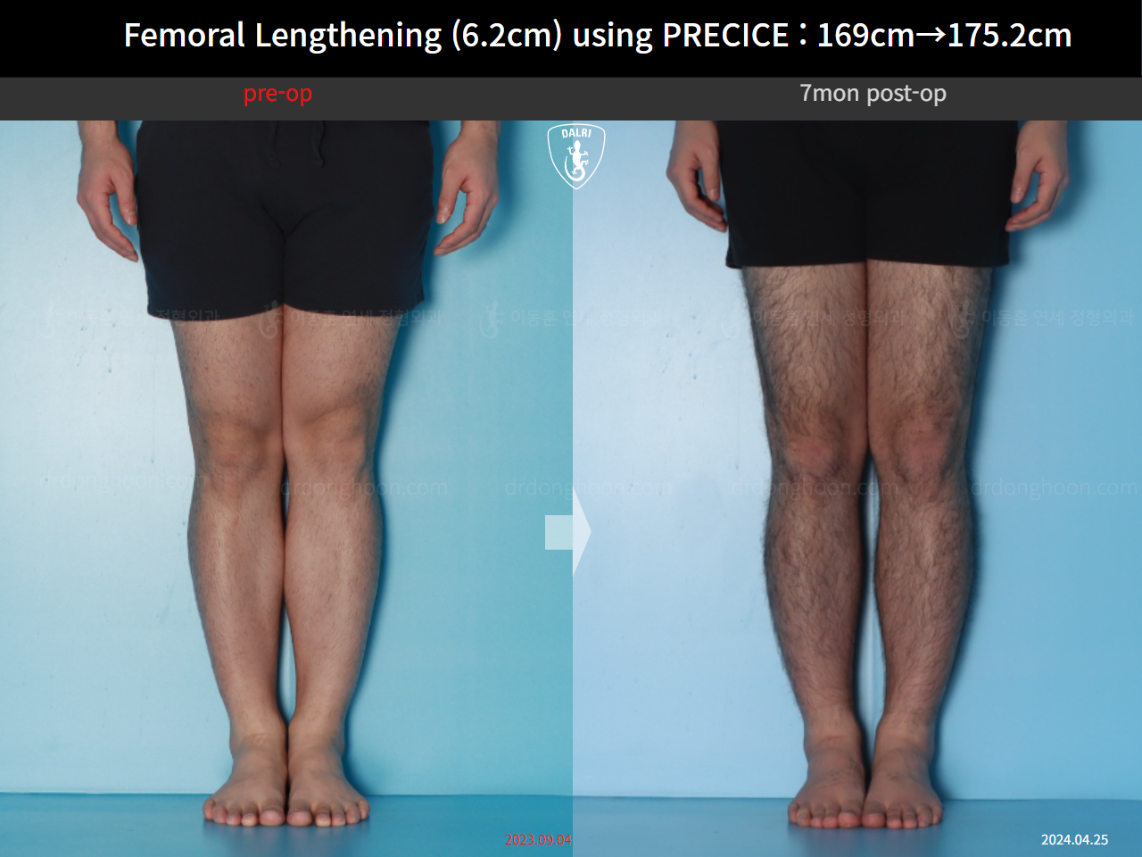 Before and after cll precice, case 20671201, image 7, Dr. Donghoon institute (DALRI)